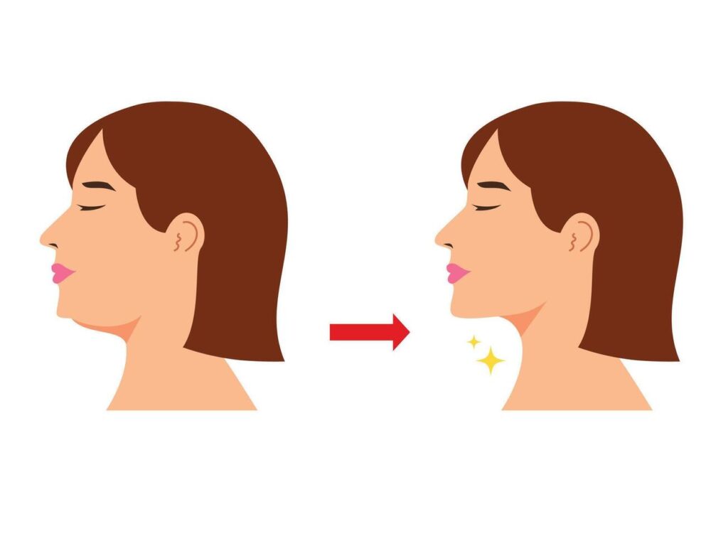 Mewing Meaning, Definition, Benefits, and Complete Internet Trend Guide 74625471 doppio mento donna con cascante secondo mento plastica chirurgia vettoriale